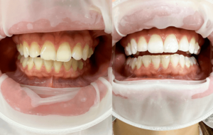 Restauração de Dente em Cerômero: Como Funciona?